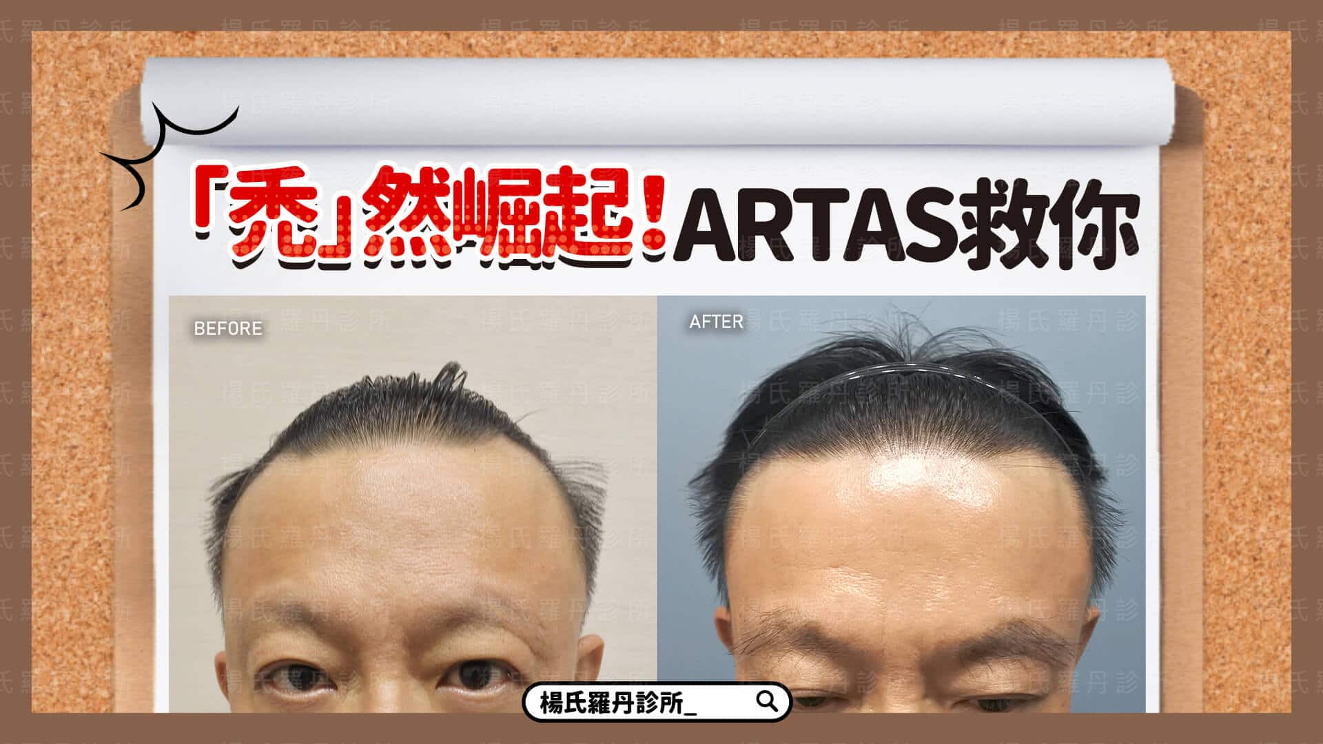 【植髮】「禿」然崛起！ARTAS植髮拯救你的頭髮與眉毛